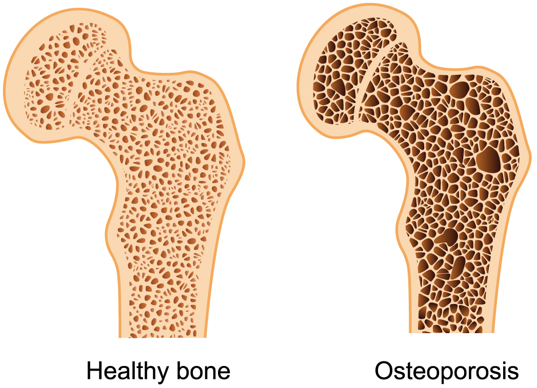 can osteoporosis become osteopenia